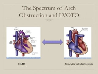 The Spectrum of Arch 
Obstruction and LVOTO 
HLHS CoA with Valvular Stenosis 
 