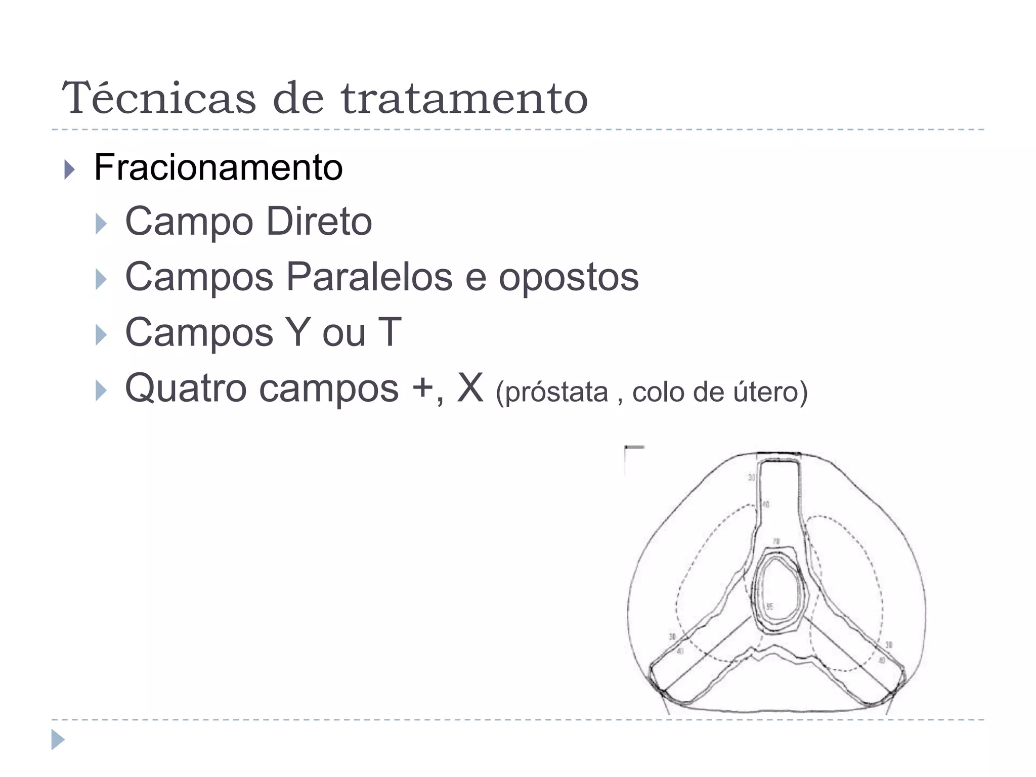 Técnicas de tratamento
   Fracionamento
       Campo Direto
       Campos Paralelos e opostos
       Campos Y ou T
       Quatro campos +, X (próstata , colo de útero)
 