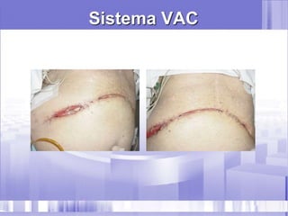 Sistema VAC
 