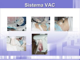 Sistema VAC
 