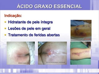 ÁCIDO GRAXO ESSENCIAL
Indicação:
 Hidratante de pele íntegra
 Lesões de pele em geral
 Tratamento de feridas abertas
 