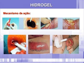 HIDROGEL
Mecanismo de ação:
 