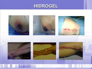 HIDROGEL
 