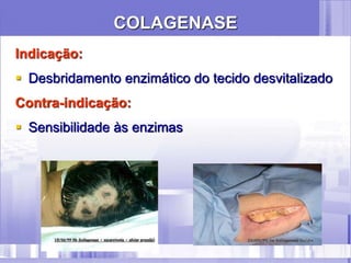 COLAGENASE
Indicação:
 Desbridamento enzimático do tecido desvitalizado
Contra-indicação:
 Sensibilidade às enzimas
 
