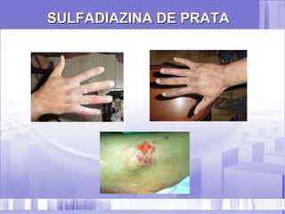 SULFADIAZINA DE PRATA
 
