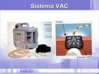 Sistema VAC
 