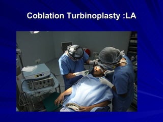 Coblation Turbinoplasty :LA
 