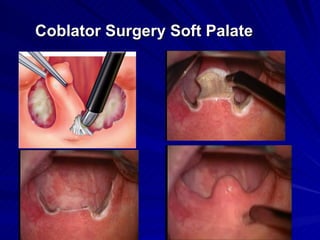 Coblator Surgery Soft Palate
 