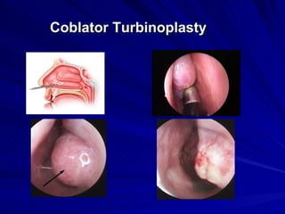 Coblator Turbinoplasty
 