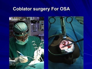 Coblator surgery For OSA
 
