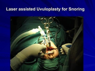 Laser assisted Uvuloplasty for Snoring
 