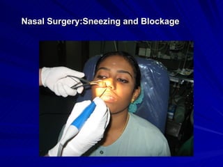 Nasal Surgery:Sneezing and Blockage
 