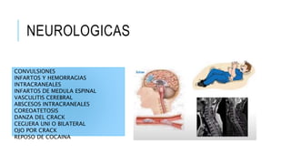 NEUROLOGICAS
CONVULSIONES
INFARTOS Y HEMORRAGIAS
INTRACRANEALES
INFARTOS DE MEDULA ESPINAL
VASCULITIS CEREBRAL
ABSCESOS INTRACRANEALES
COREOATETOSIS
DANZA DEL CRACK
CEGUERA UNI O BILATERAL
OJO POR CRACK
REPOSO DE COCAINA
 