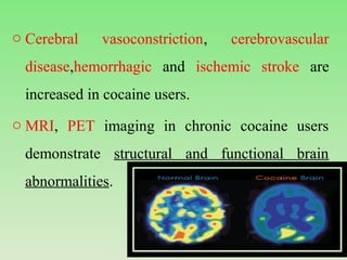 o Cerebral vasoconstriction, cerebrovascular
disease,hemorrhagic and ischemic stroke are
increased in cocaine users.
o MRI, PET imaging in chronic cocaine users
demonstrate structural and functional brain
abnormalities.
 