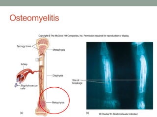 Osteomyelitis
 