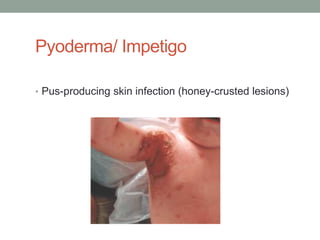 Pyoderma/ Impetigo

• Pus-producing skin infection (honey-crusted lesions)
 