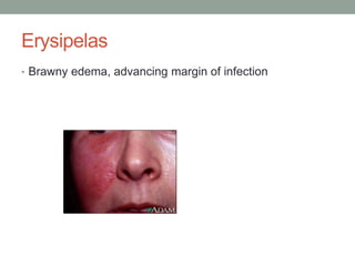 Erysipelas
• Brawny edema, advancing margin of infection
 