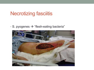 Necrotizing fasciitis

• S. pyogenes  “flesh-eating bacteria”
 