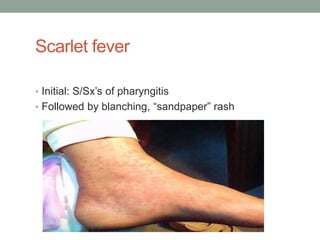 Scarlet fever

• Initial: S/Sx’s of pharyngitis
• Followed by blanching, “sandpaper” rash
 