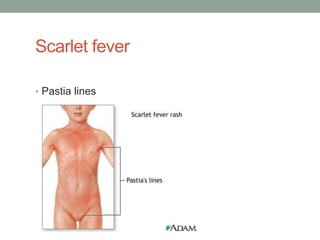 Scarlet fever

• Pastia lines
 