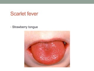 Scarlet fever

• Strawberry tongue
 