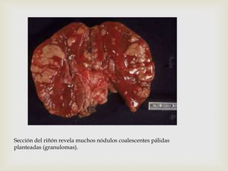 Sección del riñón revela muchos nódulos coalescentes pálidas
planteadas (granulomas).
 