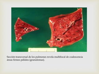 Sección transversal de los pulmones revela multifocal de coalescencia
áreas firmes pálidos (granulomas).
 