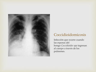 Coccidioidomicosis
Infección que ocurre cuando
las esporas del
hongo Coccidioides spp ingresan
al cuerpo a través de los
pulmones.
 