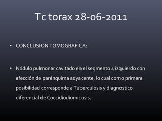 • CONCLUSION TOMOGRAFICA:
• Nódulo pulmonar cavitado en el segmento 4 izquierdo con
afección de parénquima adyacente, lo cual como primera
posibilidad corresponde a Tuberculosis y diagnostico
diferencial de Coccidiodiomicosis.
Tc torax 28-06-2011
 