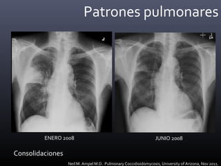 Patrones pulmonares
Neil M. Ampel M.D. Pulmonary Coccidioidomycosis, University of Arizona, Nov 2011.
ENERO 2008 JUNIO 2008
Consolidaciones
 