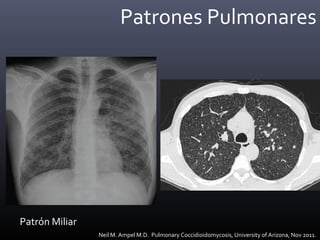 Patrones Pulmonares
Patrón Miliar
Neil M. Ampel M.D. Pulmonary Coccidioidomycosis, University of Arizona, Nov 2011.
 