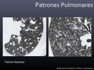 Patrones Pulmonares
Patrón Nodular
Maffessanti M, Dalpiaz G. Diffuse Lung Diseases
 