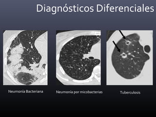 Diagnósticos Diferenciales
Neumonía Bacteriana Neumonía por micobacterias Tuberculosis
 