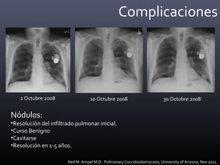 Complicaciones
Neil M. Ampel M.D. Pulmonary Coccidioidomycosis, University of Arizona, Nov 2011.
1 Octubre 2008 10 Octubre 2008 30 Octubre 2008
Nódulos:
•Resolución del infiltrado pulmonar inicial.
•Curso Benigno
•Cavitarse
•Resolución en 1-5 años.
 