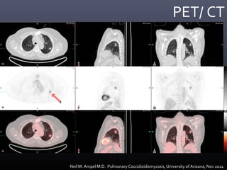 PET/ CT
Neil M. Ampel M.D. Pulmonary Coccidioidomycosis, University of Arizona, Nov 2011.
 