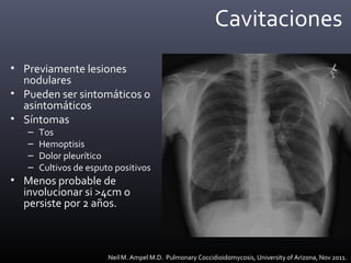 Cavitaciones
• Previamente lesiones
nodulares
• Pueden ser sintomáticos o
asintomáticos
• Síntomas
– Tos
– Hemoptisis
– Dolor pleurítico
– Cultivos de esputo positivos
• Menos probable de
involucionar si >4cm o
persiste por 2 años.
Neil M. Ampel M.D. Pulmonary Coccidioidomycosis, University of Arizona, Nov 2011.
 