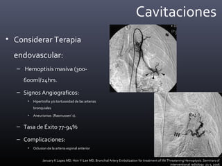 Cavitaciones
• Considerar Terapia
endovascular:
– Hemoptisis masiva (300-
600ml/24hrs.
– Signos Angiograficos:
• Hipertrofia y/o tortuosidad de las arterias
bronquiales
• Aneurismas (Rasmussen´s).
– Tasa de Éxito 77-94%
– Complicaciones:
• Oclusion de la arteria espinal anterior
January K Lopez MD. Hsin Yi Lee MD. Bronchial Artery Embolization for treatment of life Threatening Hemoptysis. Seminars of
interventional radiology 23-3, 2006
 