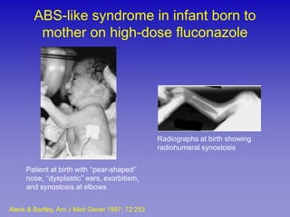 ABS-like syndrome in infant born to
         mother on high-dose fluconazole




                                               Radiographs at birth showing
                                               radiohumeral synostosis


     Patient at birth with ‘‘pear-shaped’’
     nose, ‘‘dysplastic’’ ears, exorbitism,
     and synostosis at elbows


Aleck & Bartley, Am J Med Genet 1997; 72:253
 
