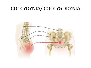 Coccygodynia