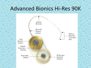 Advanced Bionics Hi-Res 90K
 