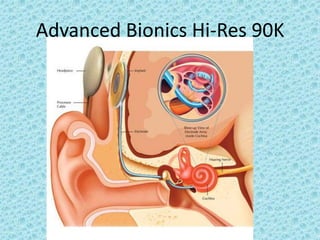 Advanced Bionics Hi-Res 90K
 