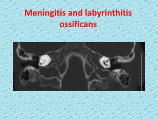 Meningitis and labyrinthitis
        ossificans
 
