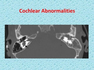 Cochlear Abnormalities
 