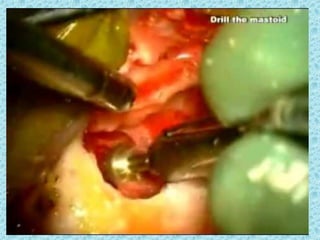 procedure
Next, using a 6 mm cutting burr, a cortical
mastoidectomy is drilled
It is not necessary to completely blueline the
sinodural angle, and doing so may interfere
with proper placement of the implant
transducer
 