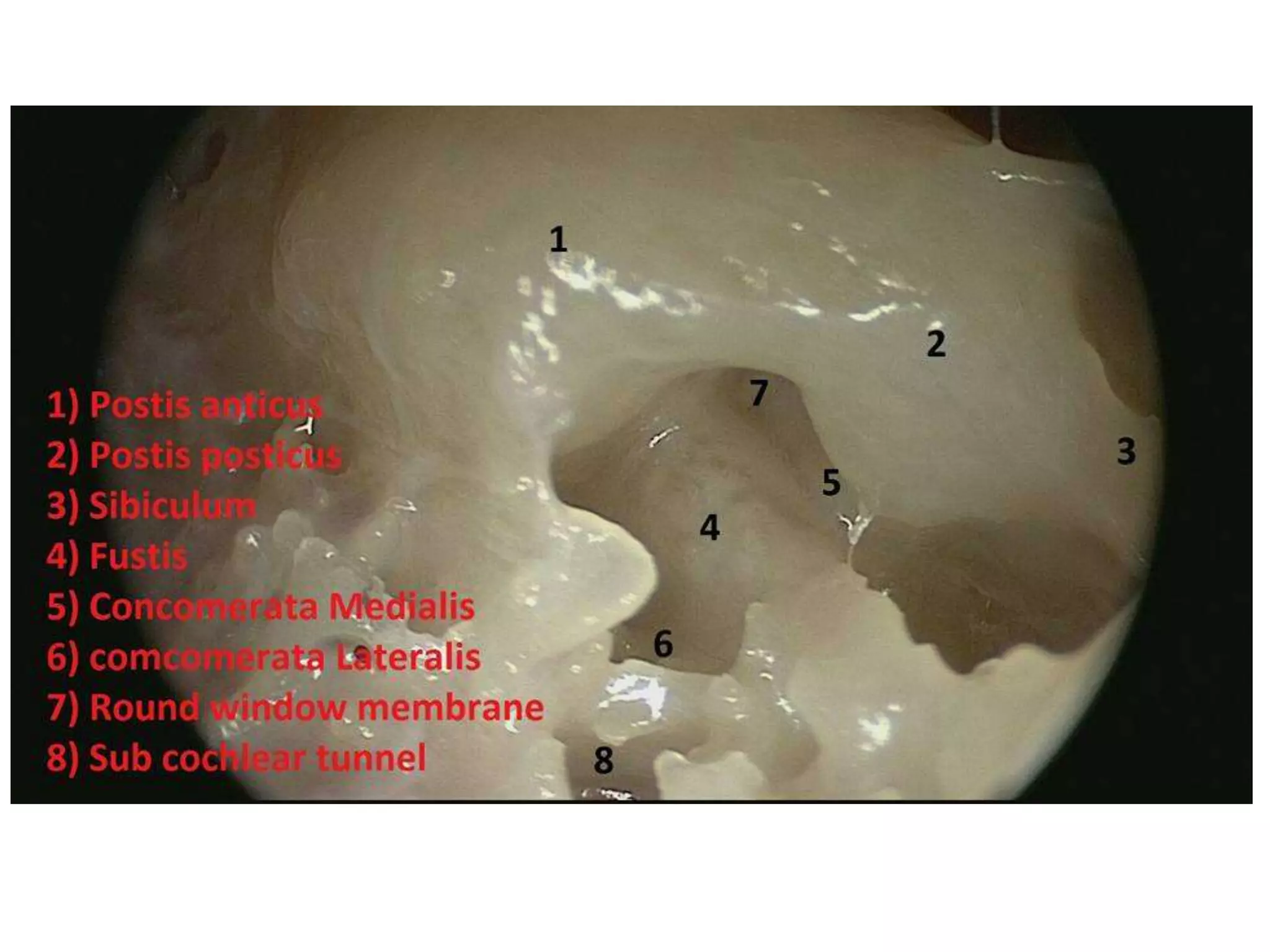 Cochlea cadaver dissection - part 1 | PPTX