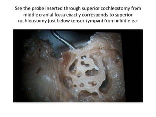 Superior cochleostomy in middle
cranial fossa is just below origin of
GSPN
 