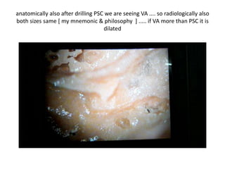 In HRCT Temporal bone Vestibular aqueduct ( VA )is seen parallel
to PSC ( Posterior semi circular canal ) Here also after drilling PSC
we are seeing VA
 