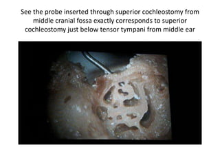 See the probe inserted through superior cochleostomy from
middle cranial fossa exactly corresponds to superior
cochleostomy just below tensor tympani from middle ear
 