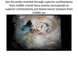 See the probe inserted through superior cochleostomy from middle cranial
fossa exactly corresponds to superior cochleostomy just below tensor
tympani from middle ear
 