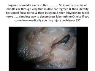 Note horizontal part of facial nerve
through middle cranial fossa as
continuation of GSPN
 